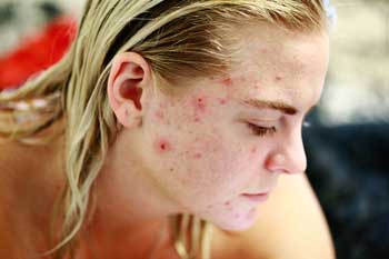Skin problems as a result of stress